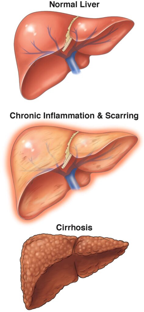 Health-related quality of life among patients with cirrhosis at a tertiary care center in Addis Ababa, Ethiopia: a cross-sectional study – Frontiers