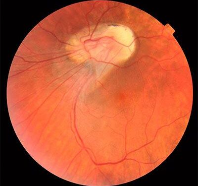 Prevalence and associated factors for retinopathy of prematurity at a tertiary hospital in Dar es Salaam, Tanzania – Nature