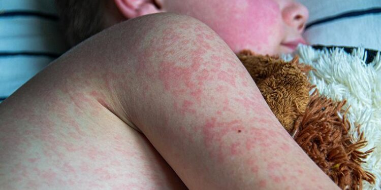 Ontario reports nearly 200 new measles cases as virus spreads across Canada – CBC
