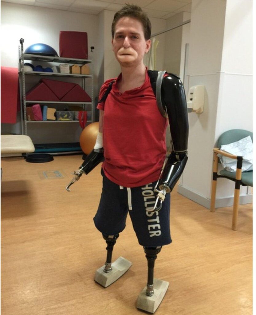 Quadruple amputee controls computer with thoughts in groundbreaking China BMI trial – China Daily