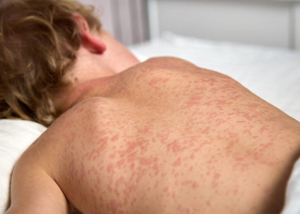 Measles warning to holidaymakers as cases rise across Europe – BBC