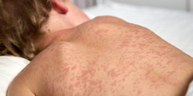 Measles warning to holidaymakers as cases rise across Europe – BBC
