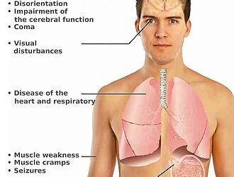 A Graph Theory Study of Resting-State Functional MRI Connectivity in Children With Carbon Monoxide Poisoning – Wiley Online Library