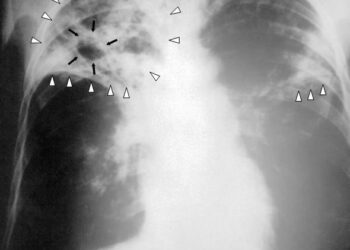 Race against TB: Lahore hosts major TB awareness camp at Expo Centre – 24 News HD