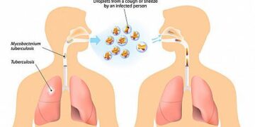 Analysis of the epidemiological characteristics of pulmonary tuberculosis in Shijiazhuang, China 2010-2023 – Frontiers