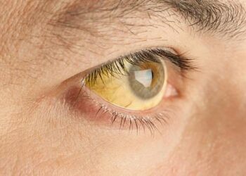 HEALTH ALERT – Yellow Fever – Practice Enhanced Precautions – U.S. Embassy in Peru (.gov)