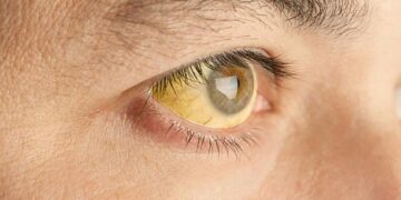 HEALTH ALERT – Yellow Fever – Practice Enhanced Precautions – U.S. Embassy in Peru (.gov)