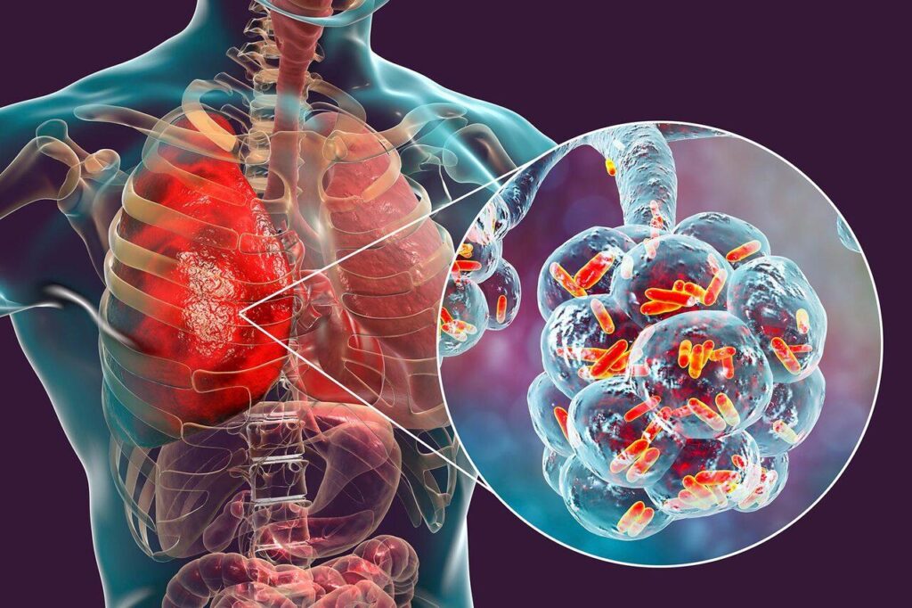 Australia health emergency: Legionnaires’ disease outbreak in Sydney’s Potts Point, 3 hospitalised; sympto – The Economic Times