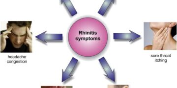 Allergic rhinitis in college students at Dongguan: a cross-sectional survey on disease burden, knowledge, and self-management – Frontiers