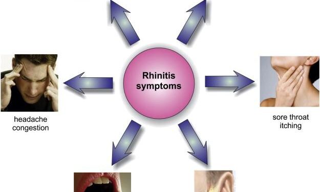 Allergic rhinitis in college students at Dongguan: a cross-sectional survey on disease burden, knowledge, and self-management – Frontiers
