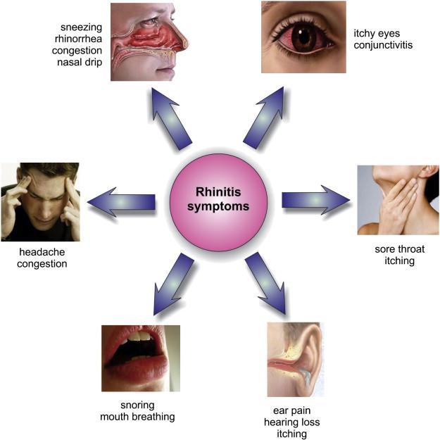 Allergic rhinitis in college students at Dongguan: a cross-sectional survey on disease burden, knowledge, and self-management – Frontiers