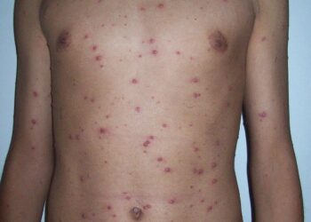A Spatial analysis of chickenpox in Chongqing, China, during 2015–2023 – Nature