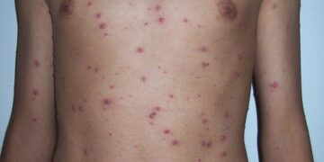 A Spatial analysis of chickenpox in Chongqing, China, during 2015–2023 – Nature