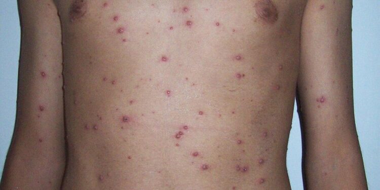 A Spatial analysis of chickenpox in Chongqing, China, during 2015–2023 – Nature