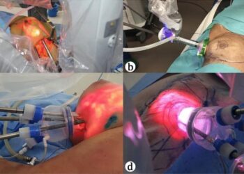 India’s first live robotic mastectomy in Pune showcased; over 150 oncologists attend – Times of India