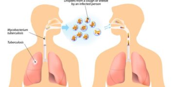 Experts review Myanmar’s progress and challenges in the fight against tuberculosis and recommend future directions – World Health Organization (WHO)