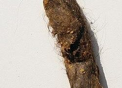 ‘World’s longest’ hairball removed from teen’s gut at Jaipur hospital – Times of India