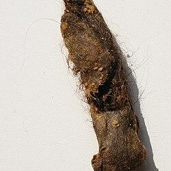 ‘World’s longest’ hairball removed from teen’s gut at Jaipur hospital – Times of India