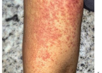 Southern China hit by outbreak of mosquito-borne infection chikungunya – Courthouse News Service