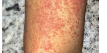 Southern China hit by outbreak of mosquito-borne infection chikungunya – Courthouse News Service