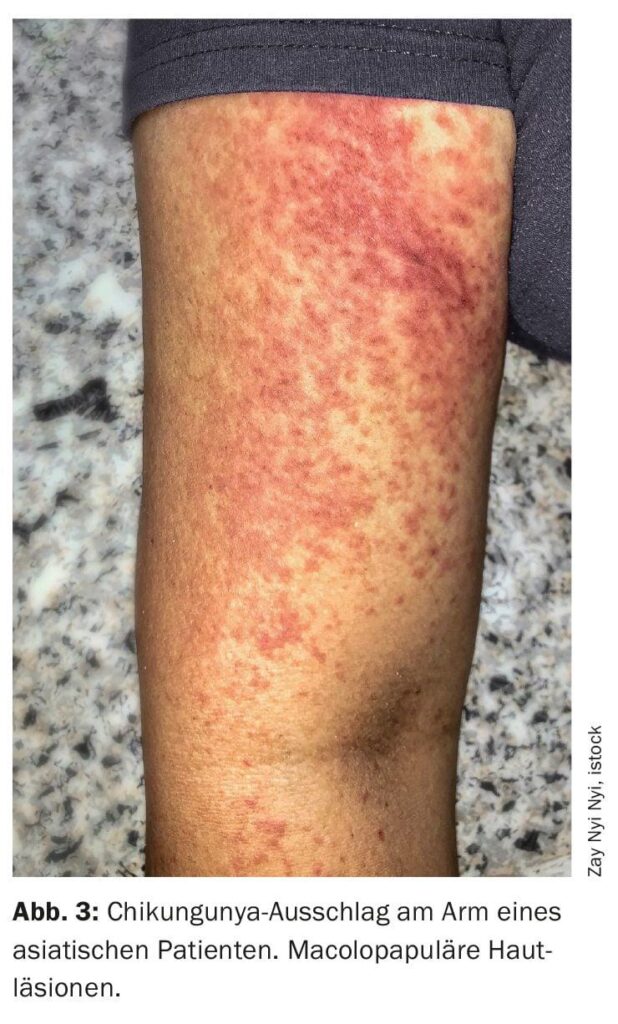 Southern China hit by outbreak of mosquito-borne infection chikungunya – Courthouse News Service