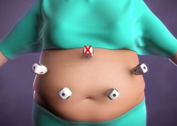 UAE hospital pioneers magnet-based weight-loss procedure – Gulf News