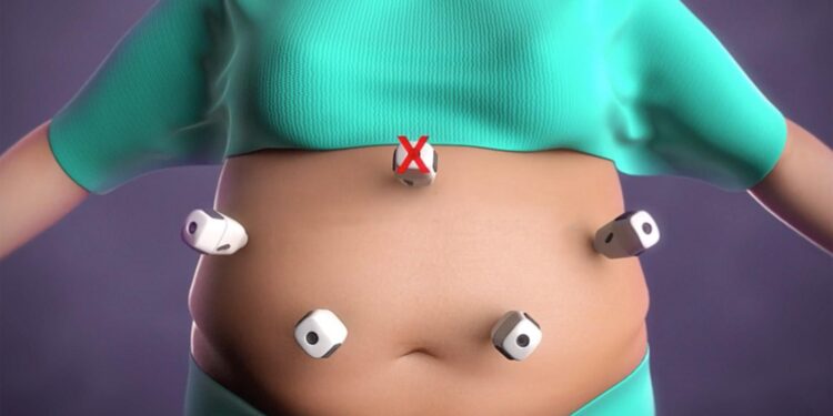 UAE hospital pioneers magnet-based weight-loss procedure – Gulf News