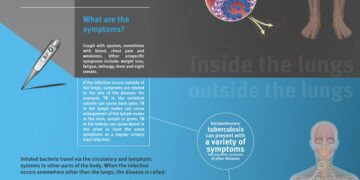 Incidence and determinants of extrapulmonary tuberculosis in Egypt: a retrospective cohort study – Nature
