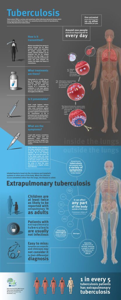 Incidence and determinants of extrapulmonary tuberculosis in Egypt: a retrospective cohort study – Nature